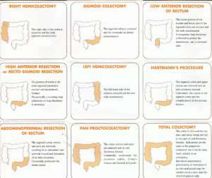Summary sheet describing the different types of colonic resections