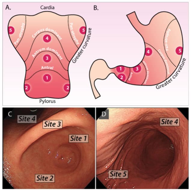 Sydney Protocol - Gastric Surveillance Biopsies